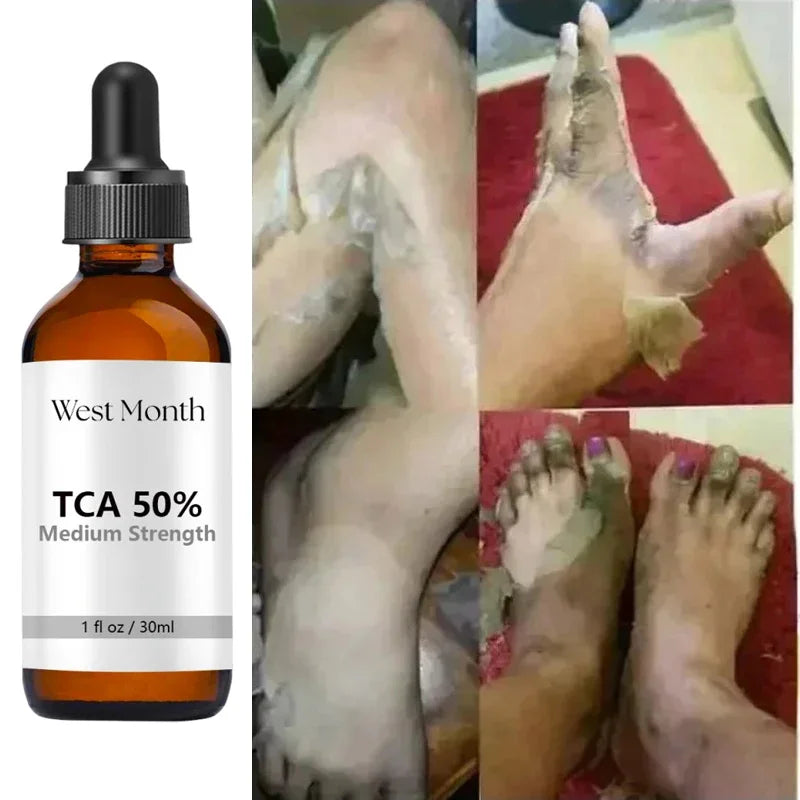 Acid Peeling Serum Chemical Exfoliant Peel For Remove Face Dark Skin Spots Whiten Lighten Melanin Peeling Solution Skin Peel
