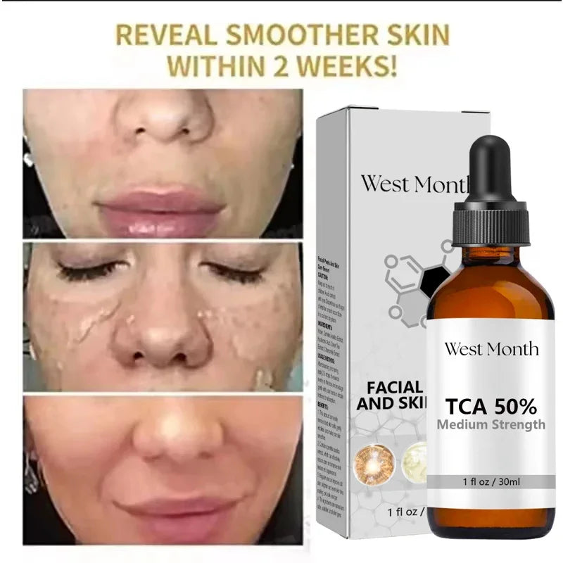 Acid Peeling Serum Chemical Exfoliant Peel For Remove Face Dark Skin Spots Whiten Lighten Melanin Peeling Solution Skin Peel