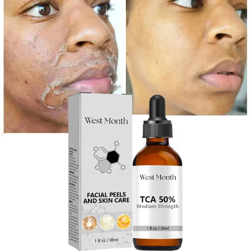 Acid Peeling Serum Chemical Exfoliant Peel For Remove Face Dark Skin Spots Whiten Lighten Melanin Peeling Solution Skin Peel