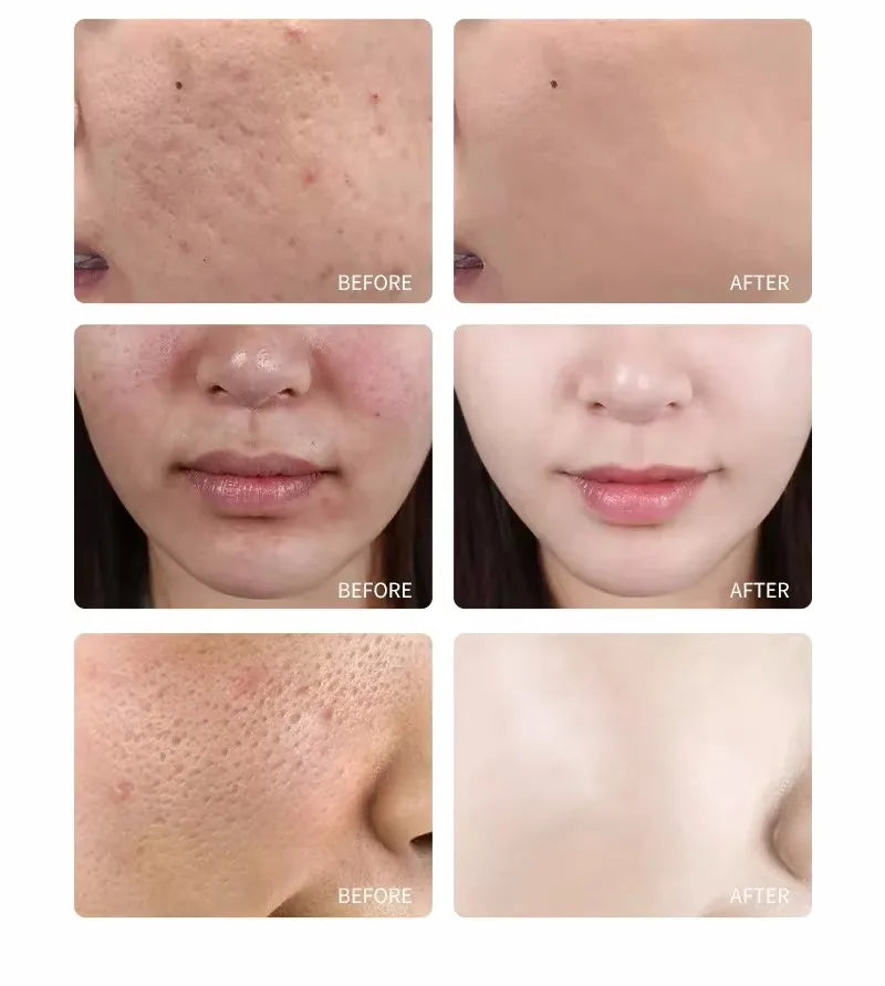 Acid Peeling Serum Chemical Exfoliant Peel For Remove Face Dark Skin Spots Whiten Lighten Melanin Peeling Solution Skin Peel